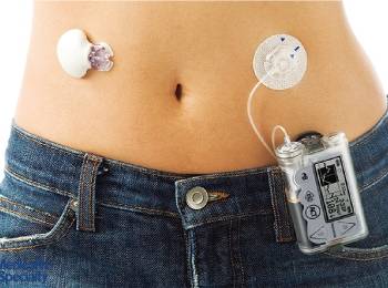 Insulin Pump